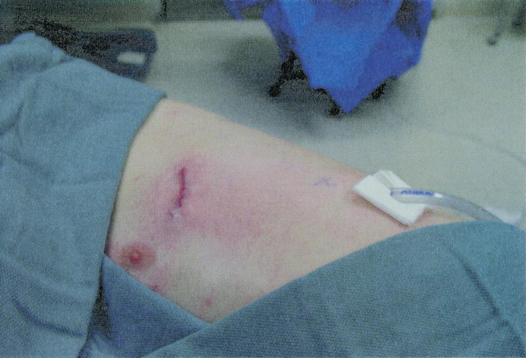 322 B.A. Whitson, R.S. Andrade, and M.A. Maddaus Figure 13 After a sustained Valsalva and port removal and closure, the VATS incisions are minimal.