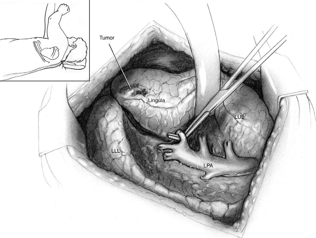 Lung segmentectomy for patients with peripheral T1 lesions 311 Operative Technique Thoracotomy Operative Approach Figure 1 At the onset of the thoracotomy, the bed is flexed slightly to extend the