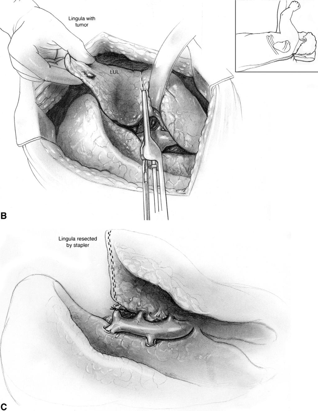 314 B.A. Whitson, R.S. Andrade, and M.A. Maddaus Figure 3 (Continued) (B) Along the line of demarcation, the lingula is removed from the surrounding parenchyma using repeated linear stapler applications with 4.