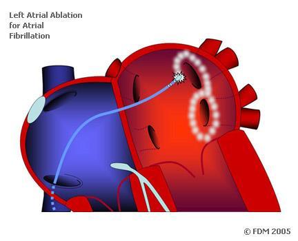 PV Isolation by Catheter Ablation AF ablation : to