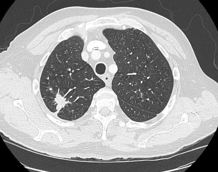 CT chest w/ contrast Multiple small nodules in the bilateral