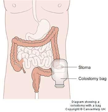 Stoma care What is a Stoma?
