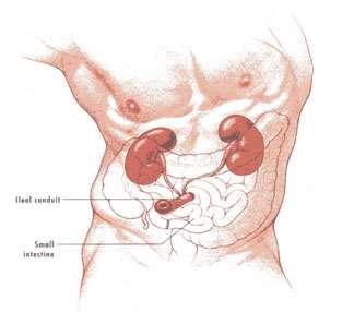 Urostomy The most common type of urostomy and it is usually sited on the left side of the abdomen.