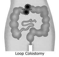 Colostomy During the operation part of the large bowel is brought to the surface of the abdomen to form the stoma, usually on the left hand side of the body.