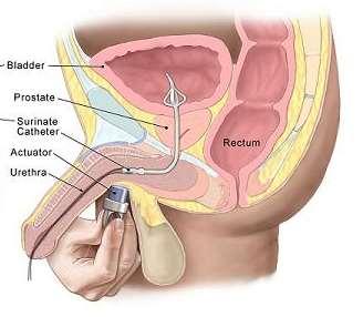 CATHETER CARE Urinary catheterisation is a medical procedure used to drain and collect urine from the bladder.
