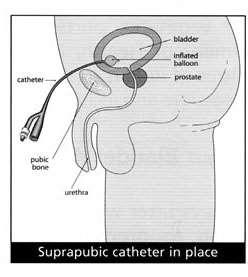 naturally passes (urethral catheter), or through a hole in your abdomen directly into the bladder (supra-pubic