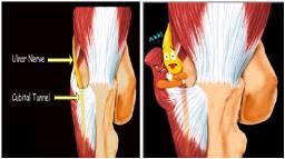 Objective Exam- Elbow Palpation TTP posteromedial olecranon at cubital tunnel Elbow AROM: R flexion pain limited Wrist AROM: R Ext pain