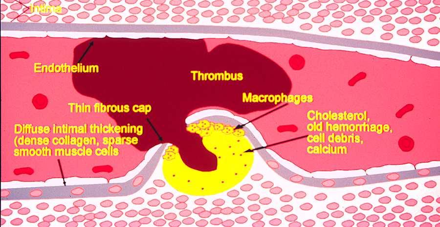 The Plaque Rupture Theory of Acute Atherothrombosis necrotic core Plaque Morphology is