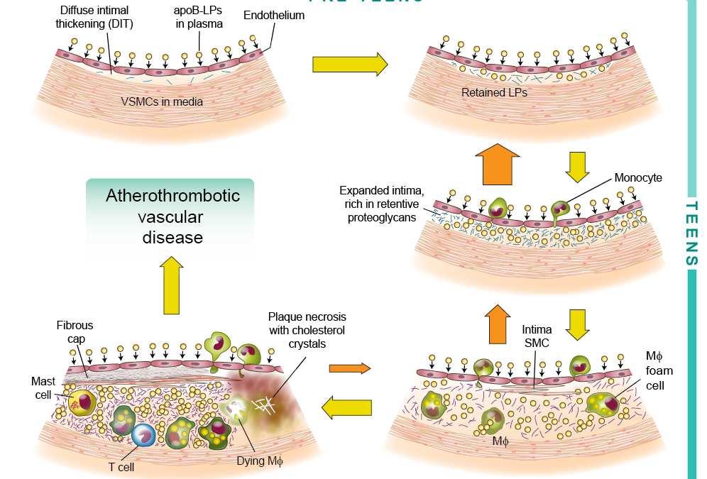 Basic Mechanisms of Atherosclerosis and Plaque Rupture Mechanisms of atherogenesis Overview Clinical implications Advanced plaque progression The maladaptive inflammatory response: defective
