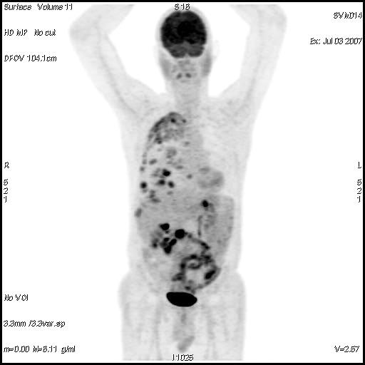 Phase I/II: PET Response in Pancreatic Cancer Baseline: 6.03.2007 8.15.