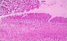 Histopathology results of Aqueous Extract Tiliacora acuminata bark of in pyloric ligation induced ulcers A B C A) Control: Rat stomach showing severe ulcer lesions and desquamation of the surface