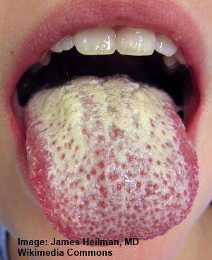 Collected from various sources http://www.healthyandnaturalworld.com/warning-signs-your-tongue-may-be-sending/ 25 1.