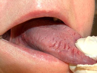 build-up of soft tissue, and are caused by repeated trauma to the lips, inside of the cheeks or tongue.