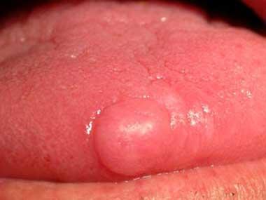 early stages. canker sore, which resolves itself within two weeks, red lesions or patches that don t go away could be serious. Get it checked immediately, doctors say.