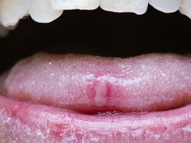 Though typically attributed to tobacco use, oral cancer can also be caused by the HPV virus.