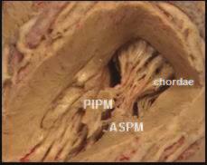 Anterosuperior (ASPM) and posteroinferior papillary muscles (PIPM) with chordae to the mitral valve. 8.