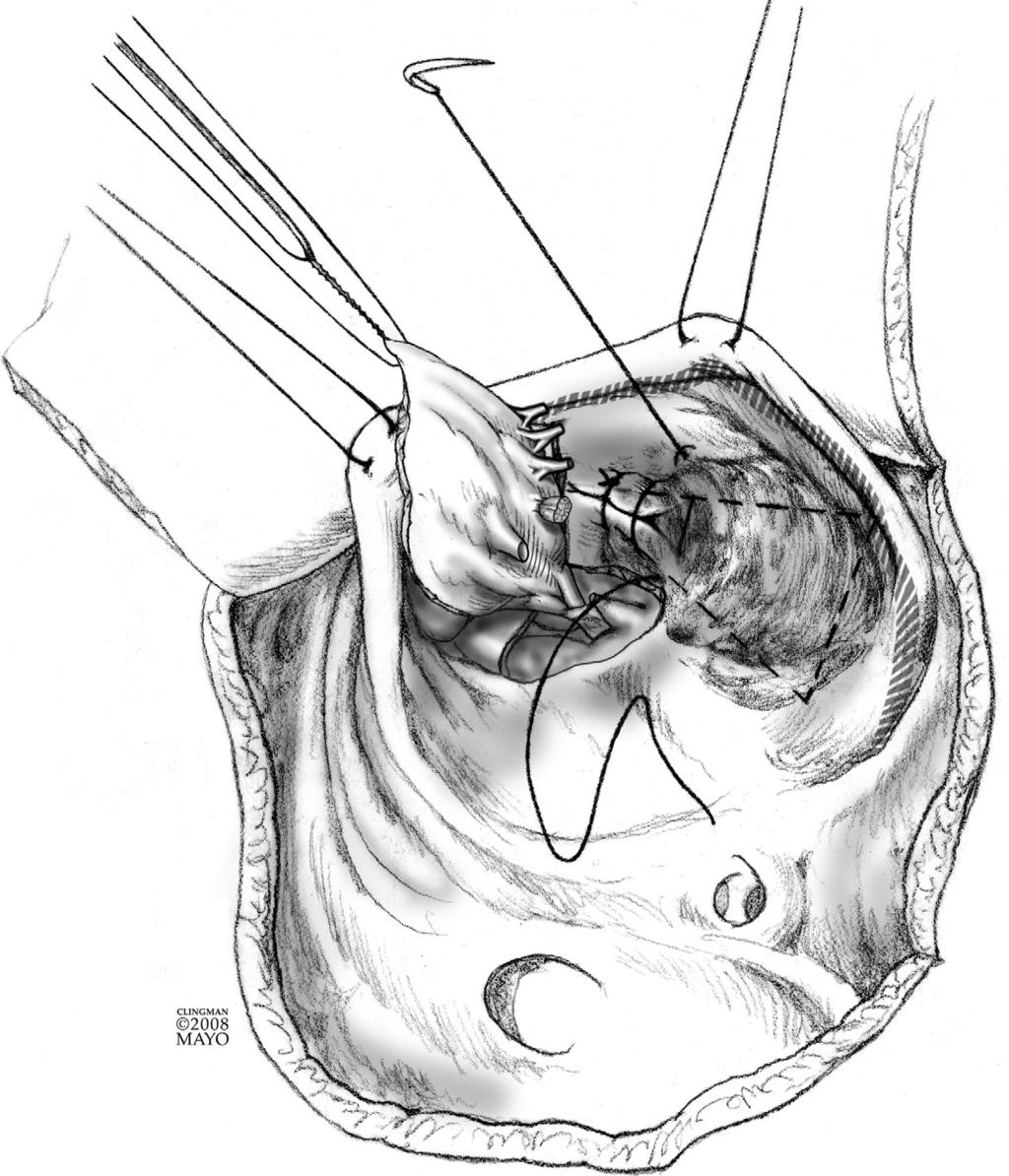 Cone reconstruction of the tricuspid valve for Ebstein s anomaly 119 Figure 10 This figure demonstrates the technique for internal plication of the atrialized right ventricle.