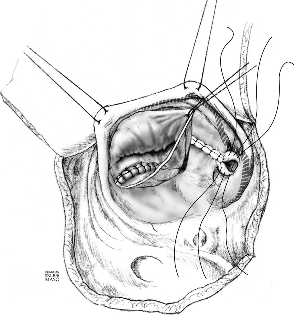 120 J.A. Dearani, E. Bacha, and J.P. da Silva Figure 11 The suture line is advanced toward the base of the heart, ie, toward the atrioventricular groove.