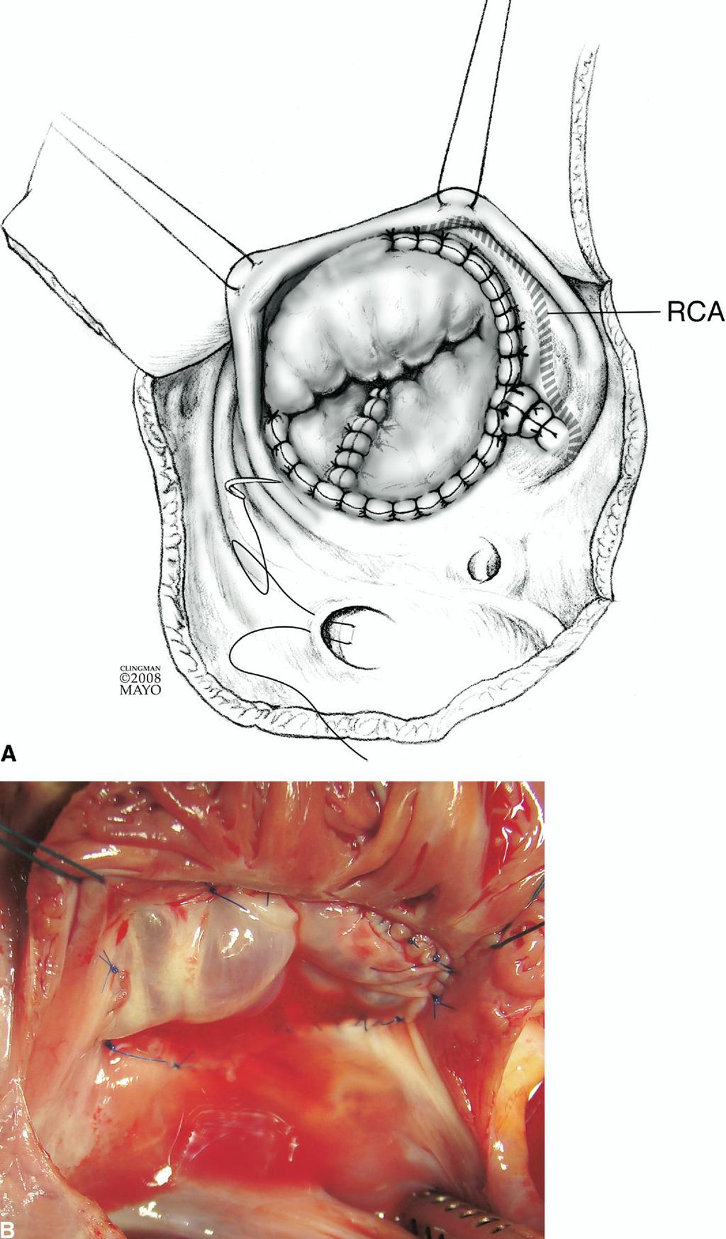 Cone reconstruction of the tricuspid valve for Ebstein s anomaly 123 Figure 14 (A) The completed cone reconstruction of the tricuspid valve.