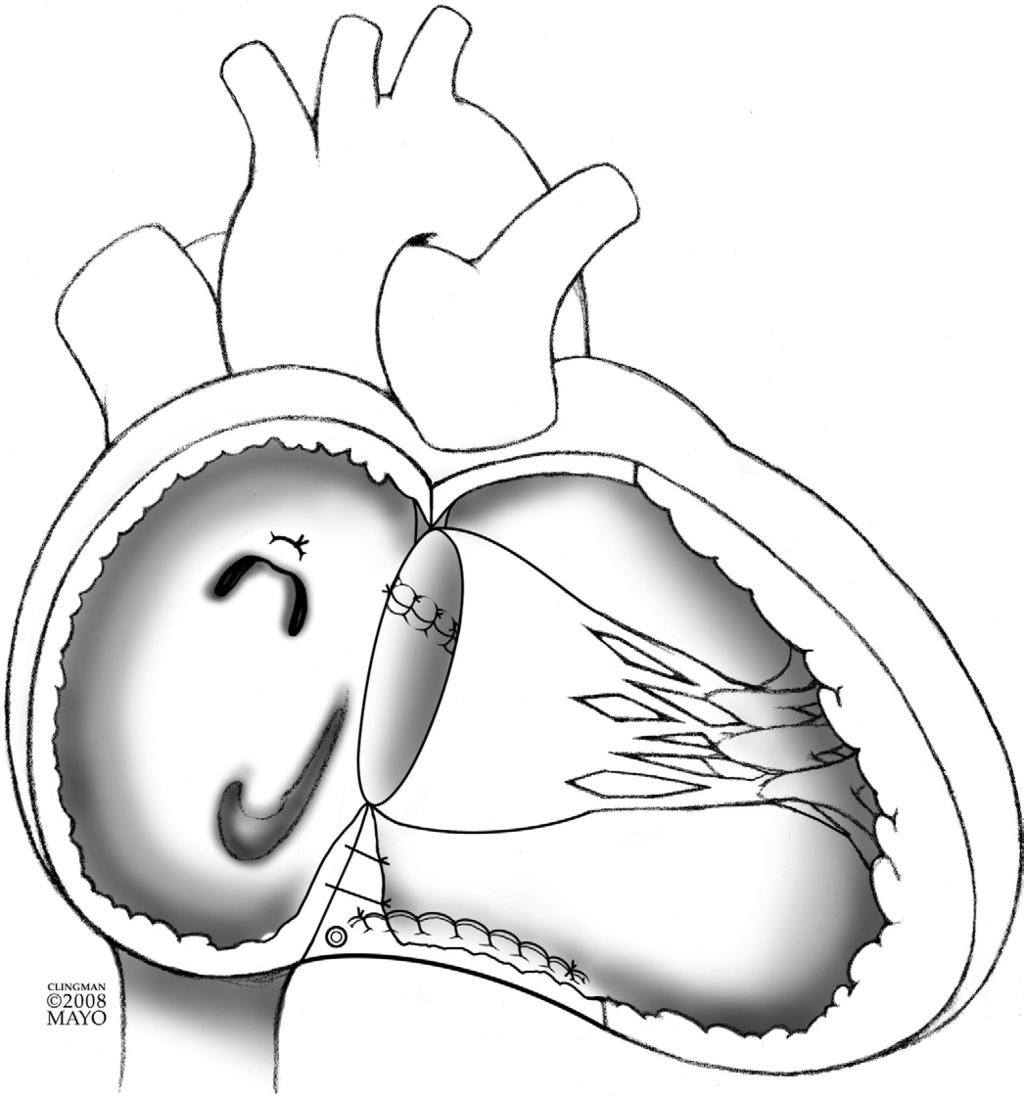 Cone reconstruction of the tricuspid valve for Ebstein s anomaly 125 Figure 16 The completed cone reconstruction of the tricuspid valve for Ebstein s anomaly.