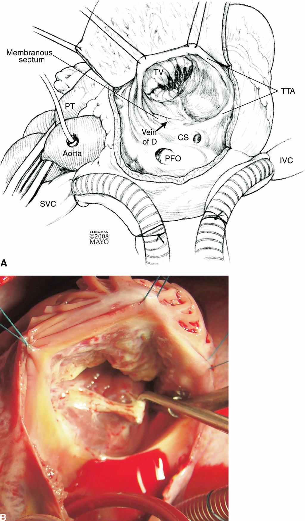 110 J.A. Dearani, E. Bacha, and J.P. da Silva Operative Technique Figure 1 (A) Operation is performed via median sternotomy. Intraoperative transesophageal echocardiogram is used routinely.
