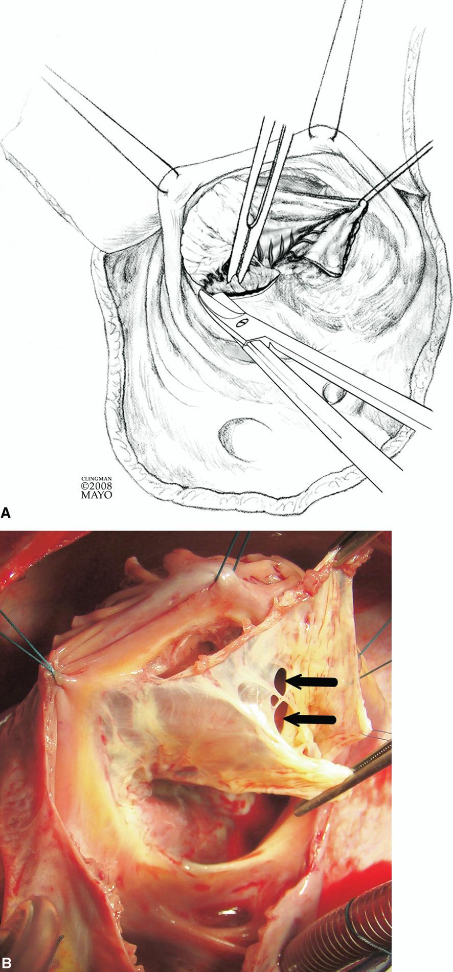 Cone reconstruction of the tricuspid valve for Ebstein s anomaly 115 Figure 6 (A) Dissection is continued with a scissors with the goal of taking down all attachments between the septal leaflet and