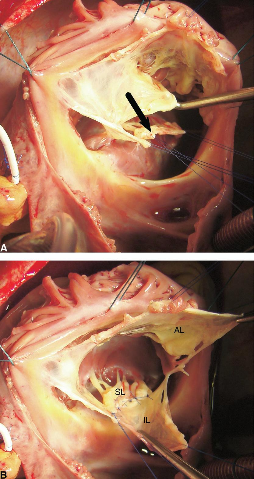 Cone reconstruction of the tricuspid valve for Ebstein s anomaly 117 Figure 8 (A) Intraoperative picture showing the mobilized anterior, inferior, and septal leaflets.