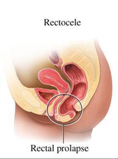 Stool can get trapped in the bulge, resulting in a feeling of incomplete emptying Rectovaginal septum (wall) Hirschsprung s disease This is a very rare condition where the lower