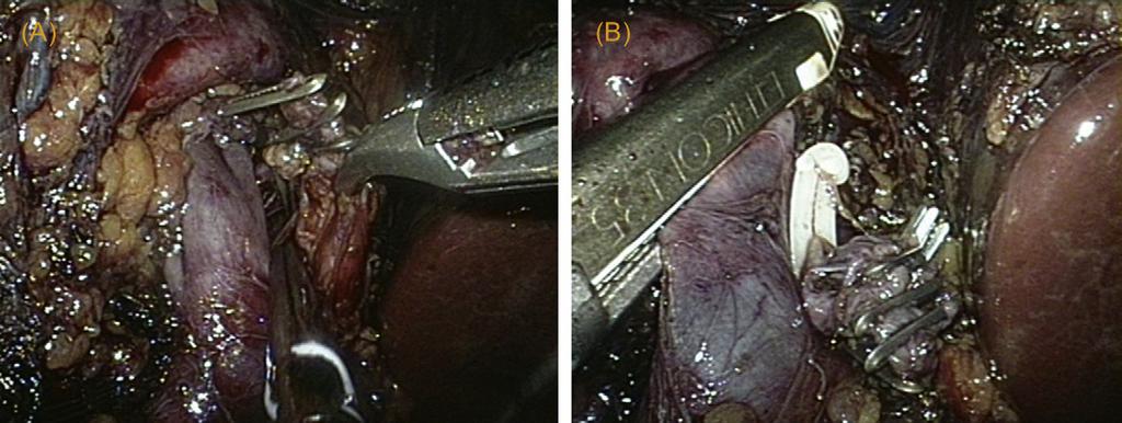 648 EUROPEAN UROLOGY 56 (2009) 644 650 Fig. 6 (A) Preparation of the renal vein; (B) ligation and dissection of the renal vein by vascular Endo GIA stapler. Fig. 7 Postoperative images of the umbilical incision (notice the limited length).