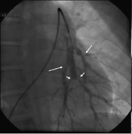 carotid siphon angioplasty was complicated by dissection