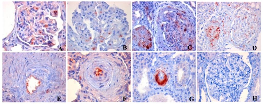 Complement AP activation in ahus Immunohistochemical analysis of C3 and C9