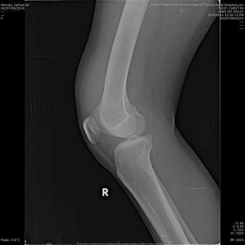 On clinical examination, she had normal gait, ligament injury or joint instability. Thickened synovium was palpable.