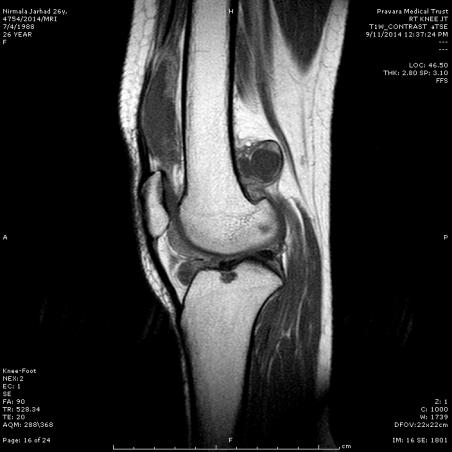 Knee AP & Lateral view MRI right knee was suggestive of synovial images.