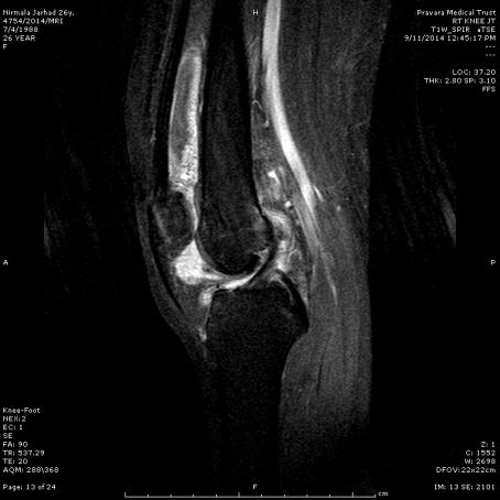 Nodular structure knee appearing hyperintense on STIR & T2W measuring 2.9 x 2.