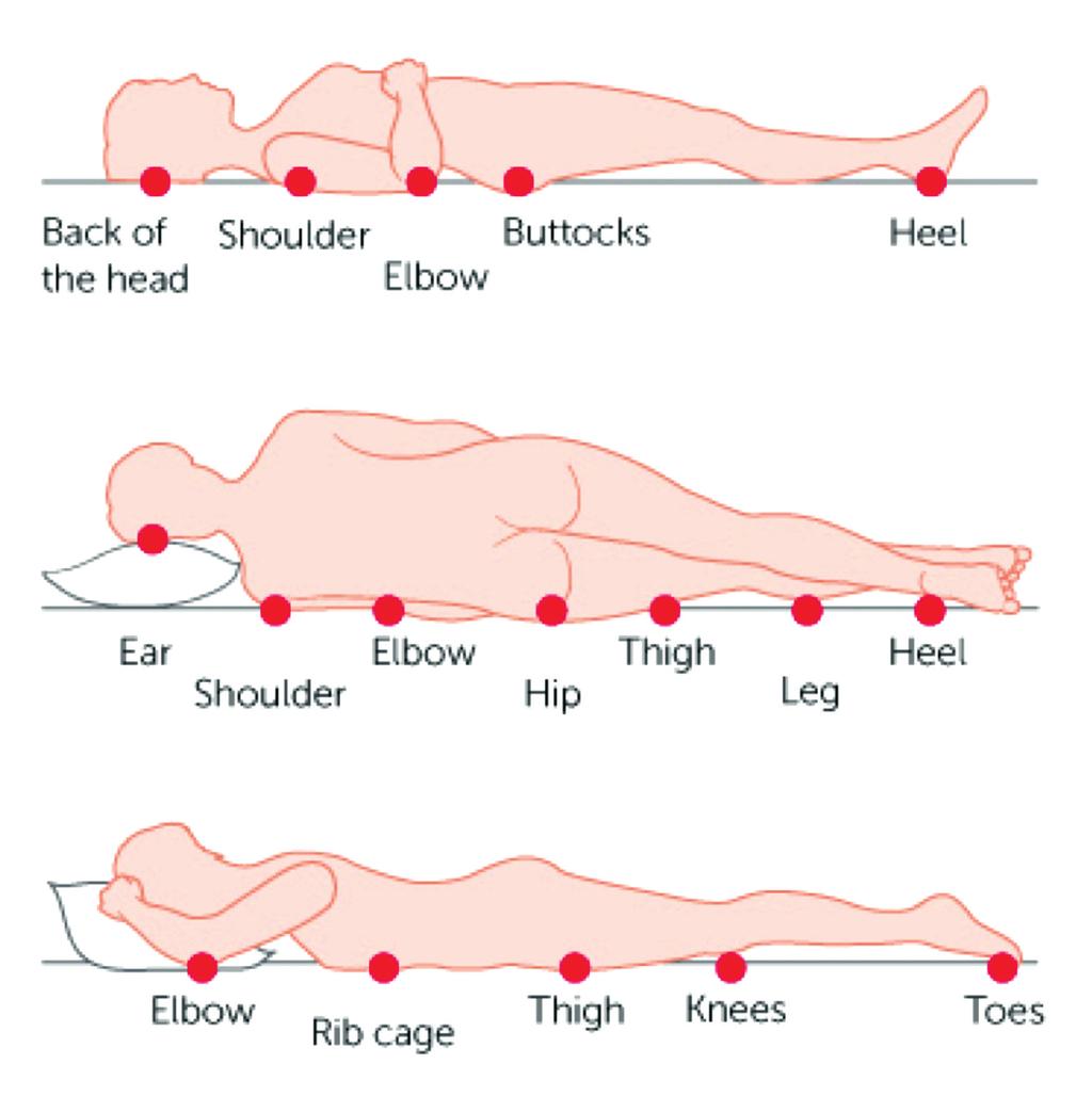 Common body sites for pressure ulcers These are normally over bony prominences, for example: Back of the head Shoulder Elbow Buttocks Heel Ear Shoulder Elbow Thigh Heel Hip Leg Elbow Rib cage Thigh