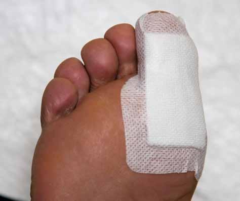 Diabetes and feet 5 steps towards healthy feet Having diabetes can cause problems with: the nerves in my feet the blood circulation in my feet Step 1. Care for my feet infection Step 2.