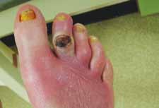 toes Ulcer Unusual