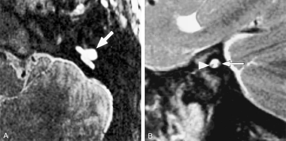 640 GLASTONBURY AJNR: 23, April 2002 FIG 3. Bilateral cochlear nerve absence in a 7-year-old patient with severe dysplasia and bilateral absence of the cochlea (patient C10).
