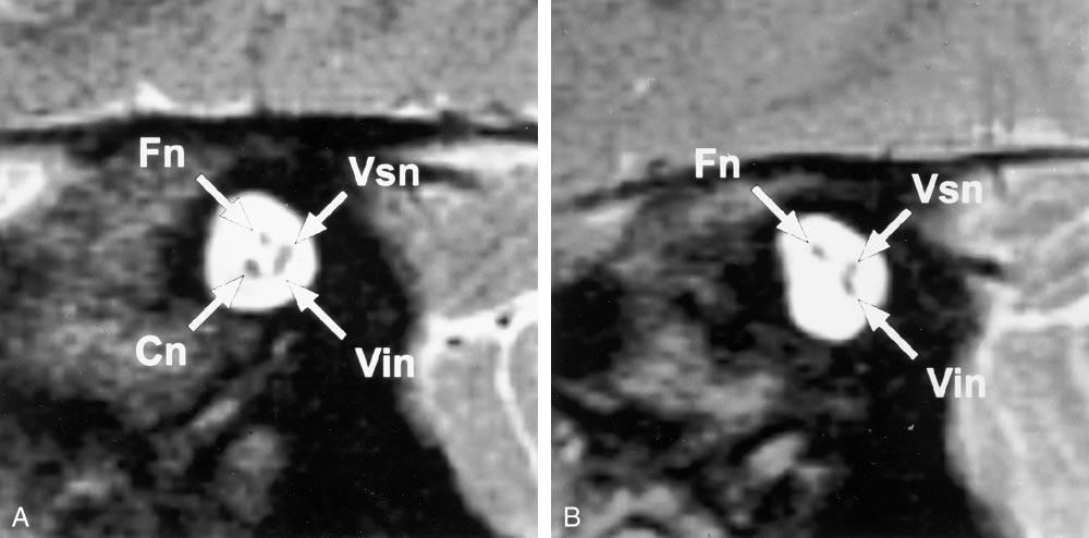 The asterisk indicates the vestibule; arrow, arterior inferior cerebellar artery (AICA) loop. B, Corresponding oblique sagittal image shows three nerves in the IAC.