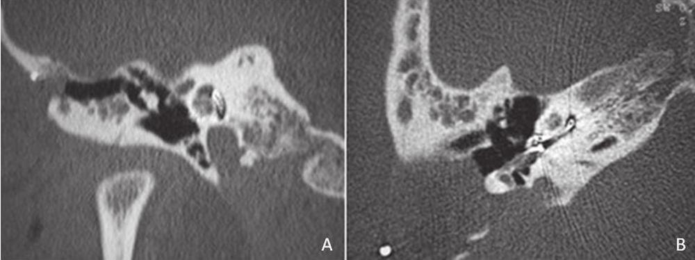 Figure 3. High-resolution coronal (A) and axial (B) CT scans of the temporal bones showing insertion of the electrode array into the middle and basal turns of the cochlea.