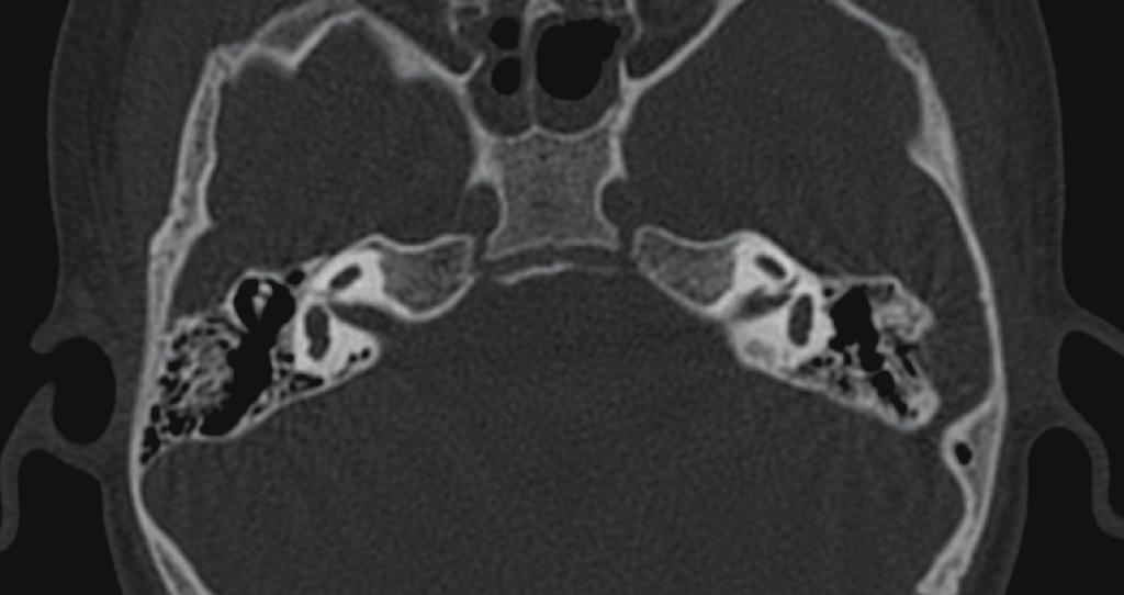 Note the absence of semicircular canals. Figure 3: Right and left coronal oblique reformation of the mastoid, using minimal intensity projection.
