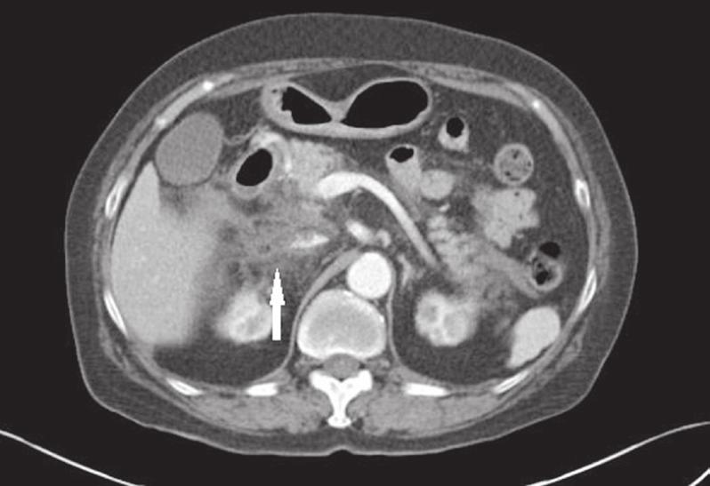 Acute pancreatitis with pulmonary embolism Case report A 76 -year-old woman with a history of hypertension and rheumatoid arthritis was admitted to an emergency department because of syncope.