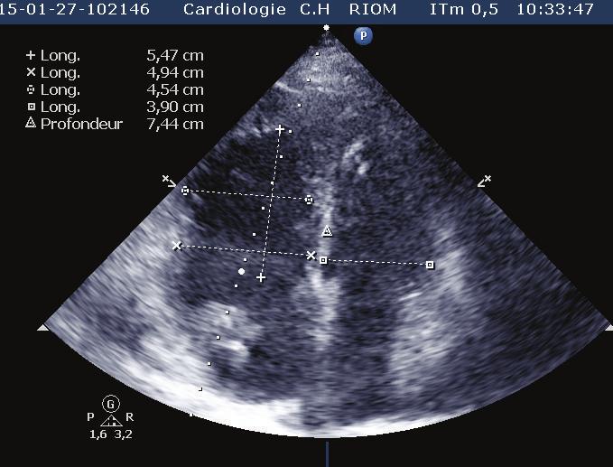 Case Reports in Cardiology 3 Figure 5: Apical four chamber view showing right ventricular dimensions (basal right ventricular diameter = 4.94 cm, mid-right ventricular diameter = 4.54 cm).