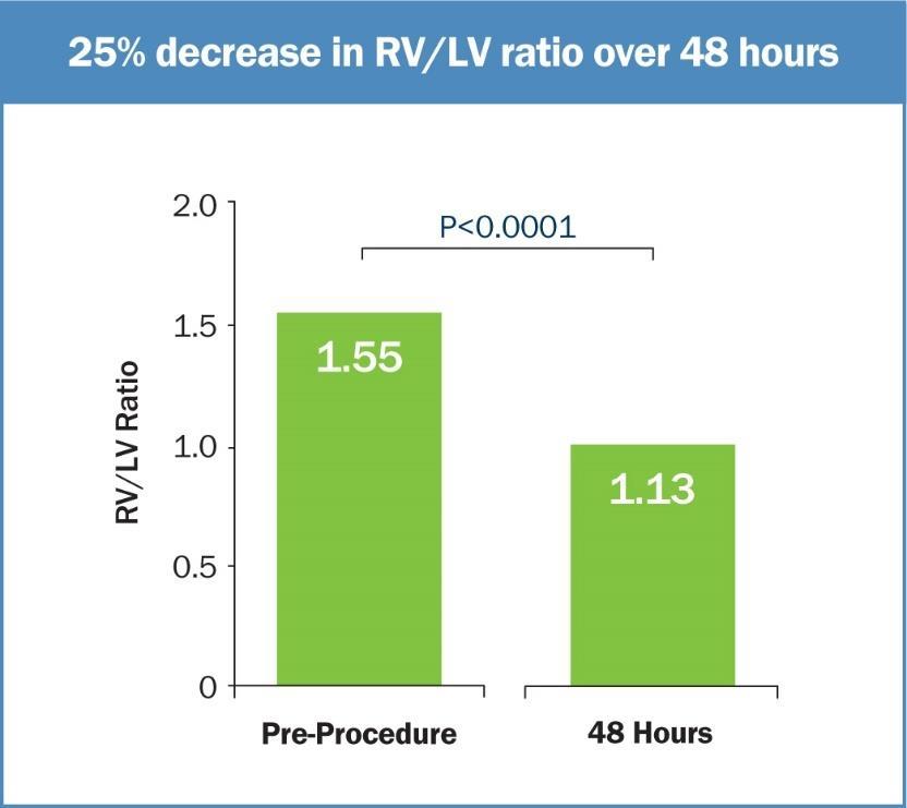 Reduced RV/LV ratio and Modified Miller Score at 48 hours post-ekos Piazza G.