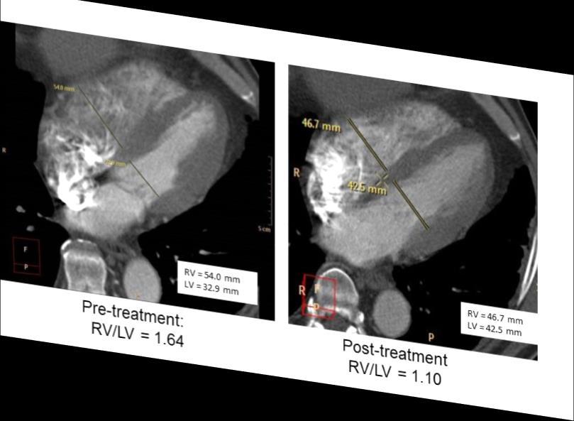 Single center experience showed CTA evidence of RVD resolution Single center retrospective single arm study 24 patients with high risk (n=5) or intermediate risk (n=19) PE treated with EKOS Mean rtpa