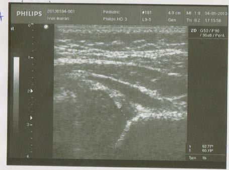 We found mature hips at all control hips ultrasound performed at 2 months after starting treatment,