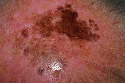 Pigmented Lesions of the Oral Mucosa 11 Fig. 14 Superficial spreading melanoma of the scalp (1.2 mm in depth) in an 86-year-old male (Photo courtesy: Dr.