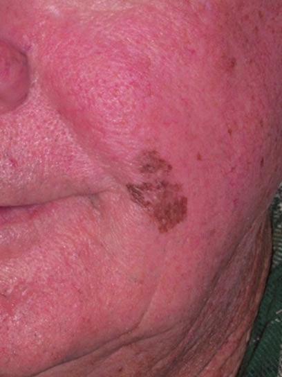 Simon Lee, Head of Surgery, The Skin Hospital, Darlinghurst, NSW, Australia) Fig. 15 Superficial spreading melanoma of the cheek (0.7 mm in depth) in a 71-year-old male (Photo courtesy: Dr.