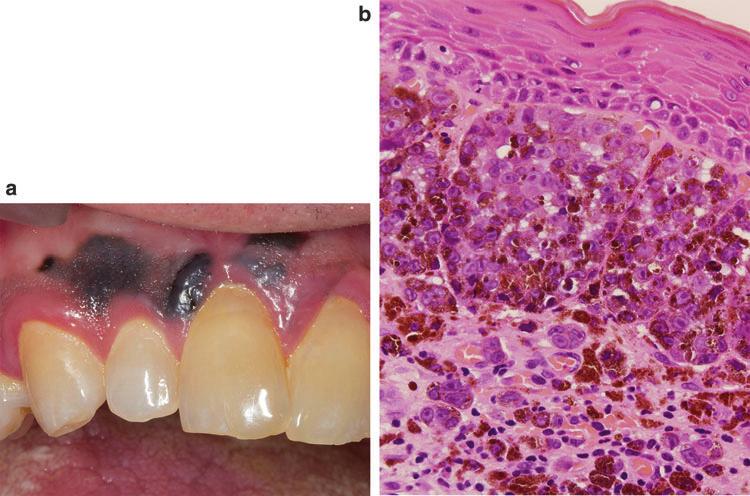 Pigmented Lesions of the Oral Mucosa 13 Fig.