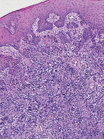 14 E.T. Stoopler and F. Alawi Fig. 21 Anti-HMB45 immunohistochemical analysis. The malignant tumor cells (see Fig.